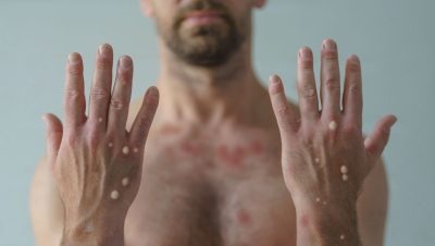 Três Lagoas notifica mais 3 casos da Varíola Monkeypox